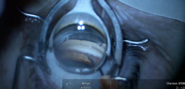 Hydrus Microstent With ORA thumbnail