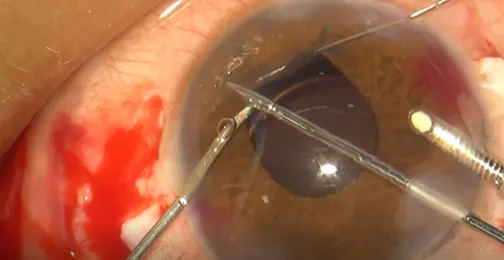 Reverse Four-Throw Pupilloplasty