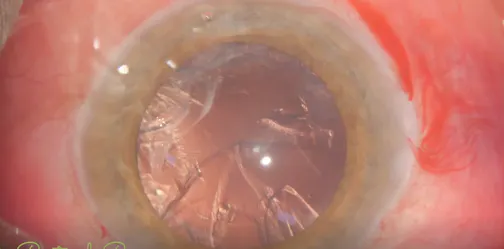 Topical Hepta Procedure