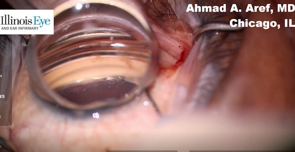 Combination Streamline, Hydrus, Phaco, and Eyhance IOL thumbnail