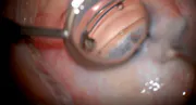 Standalone Implantation of iStent Infinite