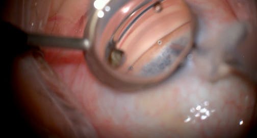 Standalone Implantation of iStent Infinite