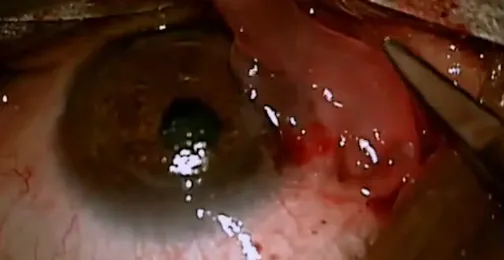 Amniotic Membrane to the Rescue of a Corneal Graft