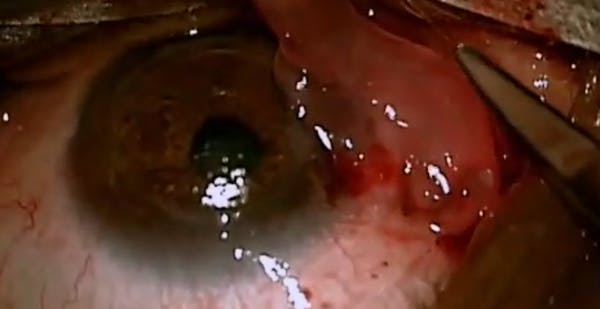 Amniotic Membrane to the Rescue of a Corneal Graft thumbnail
