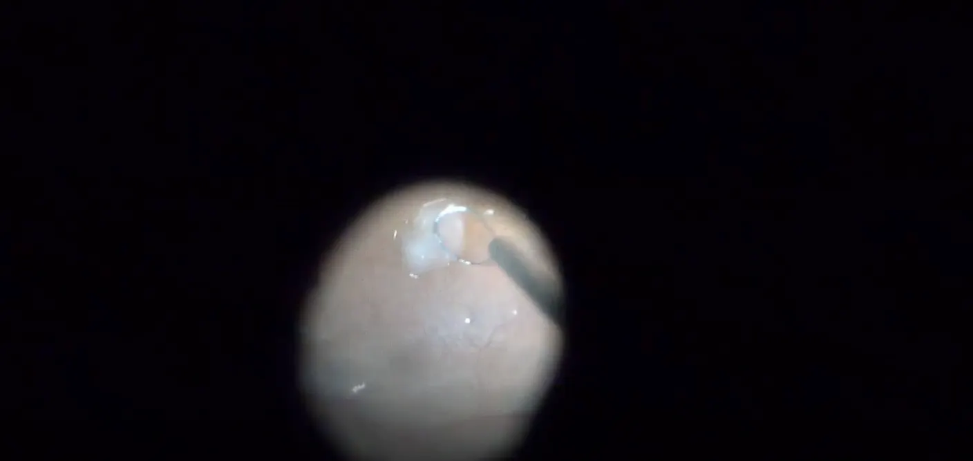 Autologous Retinal Transplant for Macular Hole During Retinal ...
