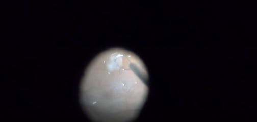 Autologous Retinal Transplant for Macular Hole During Retinal Detachment Repair