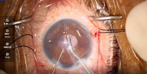 Benefits of Vacuum in a Small Pupil