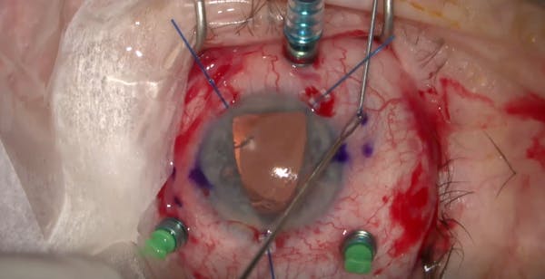 Complicated Cataract Surgery in Elderly Patient thumbnail