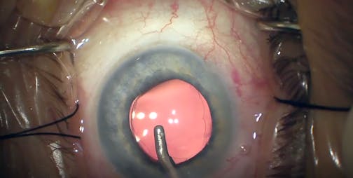 Hydrus Scaffolding and Blanching