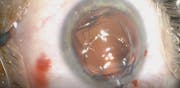 Psuedophakic IOL Explantation