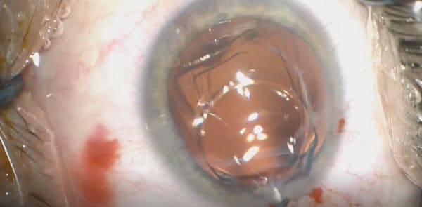 Psuedophakic IOL Explantation thumbnail