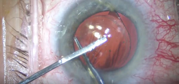 Twist-and-Out Technique thumbnail