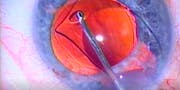 Criss-Cross Lensectomy