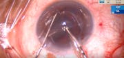 Quadrisection