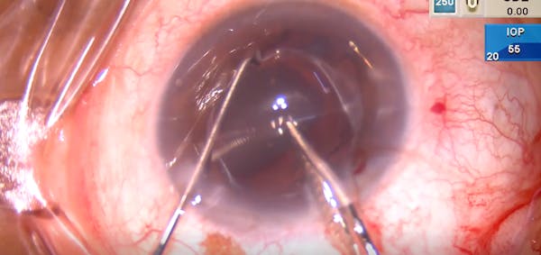 Quadrisection thumbnail