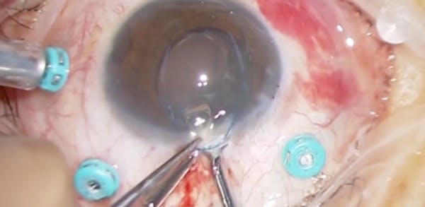 Cartridge Pull-through Technique thumbnail
