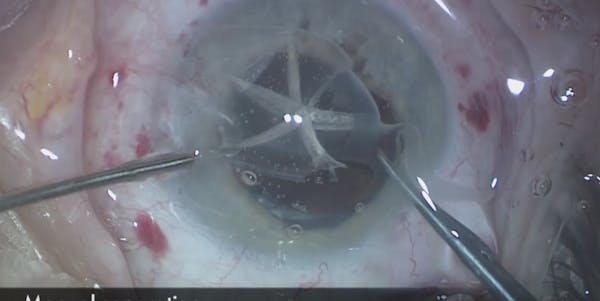 Femtosecond Laser-Assisted IOL Removal (FLAIR) thumbnail