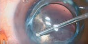 Optic Transplant