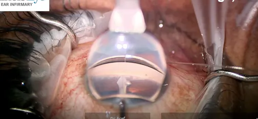 ABIC With GATT Using GonioReady System