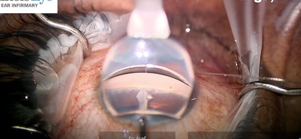 ABIC With GATT Using GonioReady System thumbnail