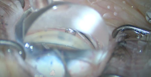 Chronic Angle Closure Glaucoma thumbnail