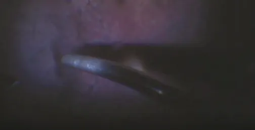 Surgical Considerations of Gene Therapy