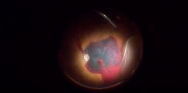 Iatrogenic Retinal Detachment During Submacular Hematoma Repair thumbnail