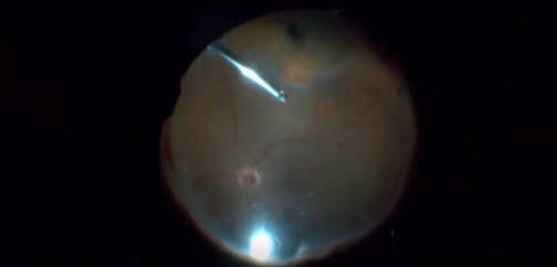 Ocular Perforating Injury Repair