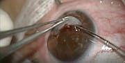 Triple Procedure for Uveitic Cataract With Adherent Leukoma