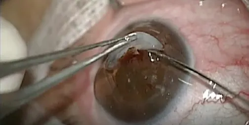 Triple Procedure for Uveitic Cataract With Adherent Leukoma
