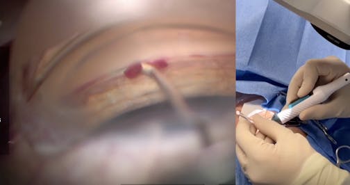 Maximizing Outflow With iPrime