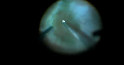 Retinal Vasculopathy and ADNIV