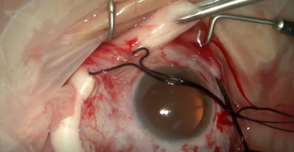 Chandelier-Assisted Scleral Buckling Procedure thumbnail