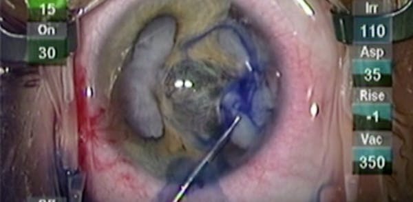 Anterior Segment Reconstruction Following BB Gun Injury thumbnail