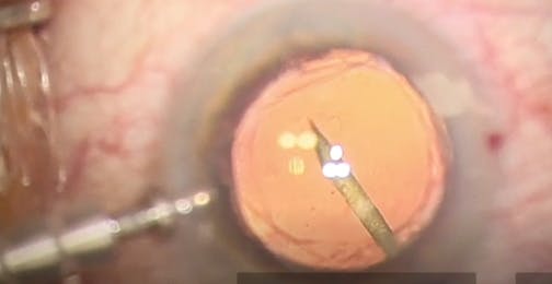 Limited Vitreous Removal