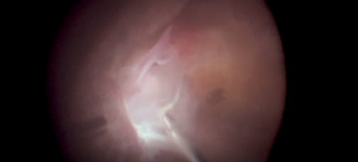 Minimally Invasive Vitrectomy in Severe Diabetic Retinopathy