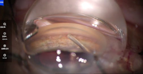 iTrack Advance Ab Interno Canaloplasty