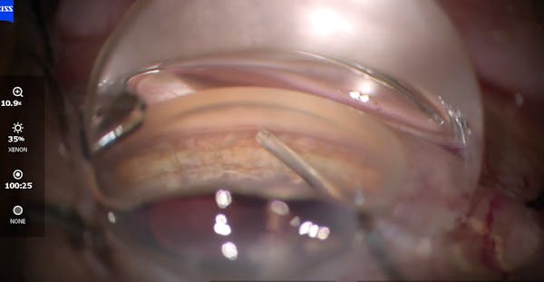 iTrack Advance Ab Interno Canaloplasty thumbnail