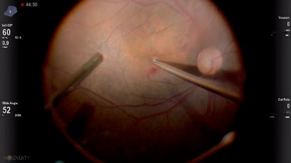 Induction of Macular Detachment for Persistent Full-Thickness Macular Hole thumbnail