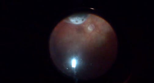 Combined Procedure for High Myopia and Chronic Retinal Detachment
