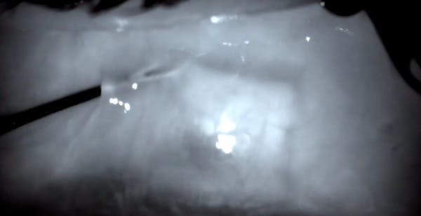 Infrared-Assisted Deep Sclerectomy Slit-Lamp Needling thumbnail