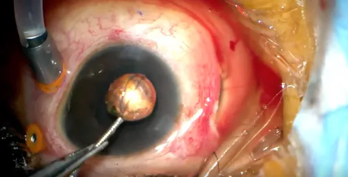 Intraocular BB Pellet