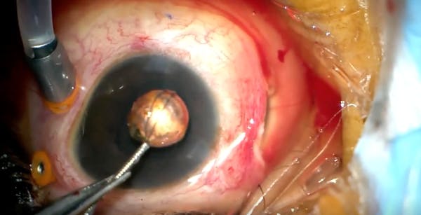 Intraocular BB Pellet thumbnail