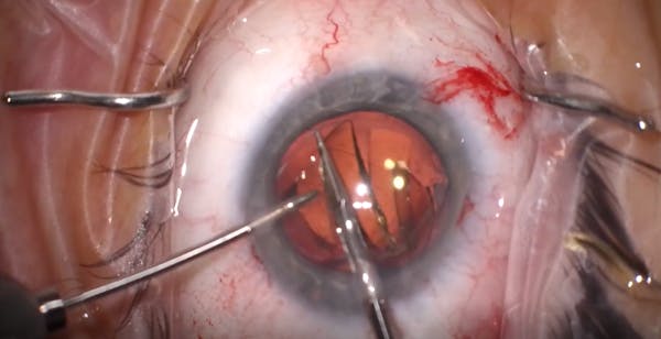 IOL Exchange Using a Posterior Capsulorhexis for Implant Fixation thumbnail