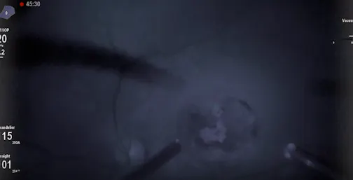 Intraoperative Fluorescein Angioscopy to Diagnose Broken Retinal Aneurysm