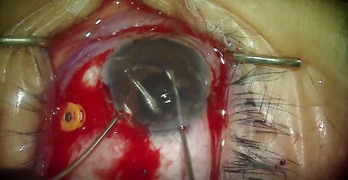 Exchange of Haptic-Fixated IOL With Excessive Tilt