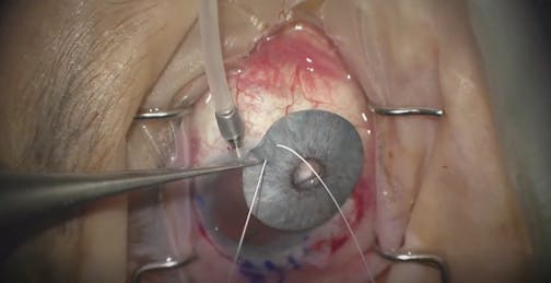 Double Exchange of Iris Prosthesis and IOL