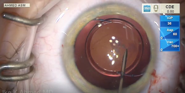 Congenital Posterior Polar Cataract thumbnail