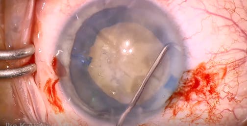 Traumatic Dense Cataract, Capsular Fibrosis, and Atonic Pupil