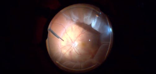 Refractory Retinal Detachment